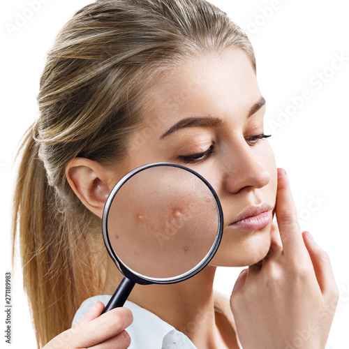 Young woman with magnifying glass shows skin with acne.