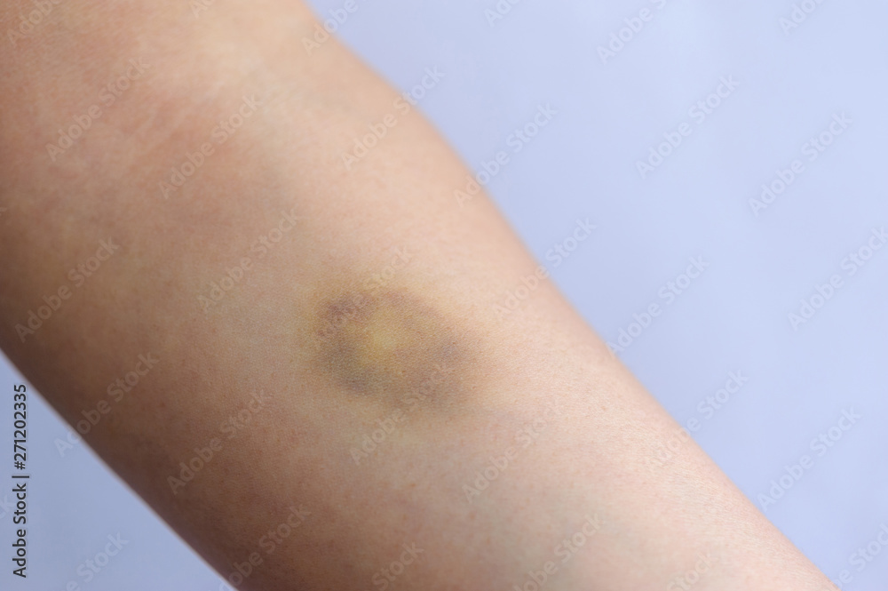 people with bruised arm closeup people with bruised arm closeup