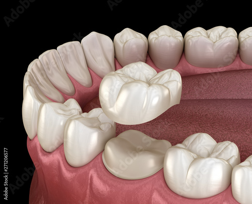 Fototapeta Naklejka Na Ścianę i Meble -  Preparated molar tooth for dental crown placement. Medically accurate 3D illustration