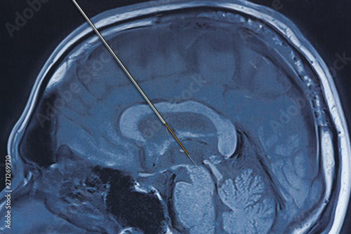 Quadro su tela Concept of brain recording for parkinson surgery