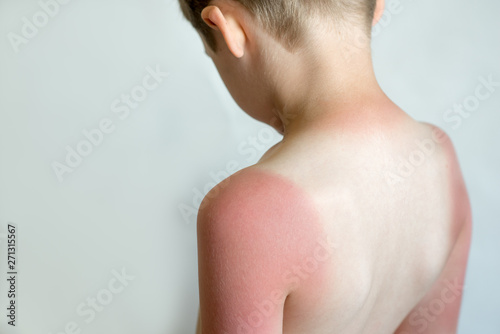 Strong tan in the boy. Red hands and back. Sore skin, blistered. No sun protection