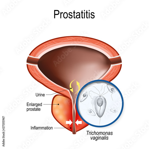 prostatitis and close-up of Trichomonas vaginalis photo