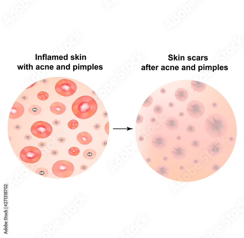 Types of blackheads, pustule, acne. Scarred skin after acne and acne. Infographics. Vector illustration on isolated background.