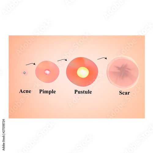 Types of blackheads, pustule, acne. Scarred skin after acne and acne. Infographics. Vector illustration on isolated background.