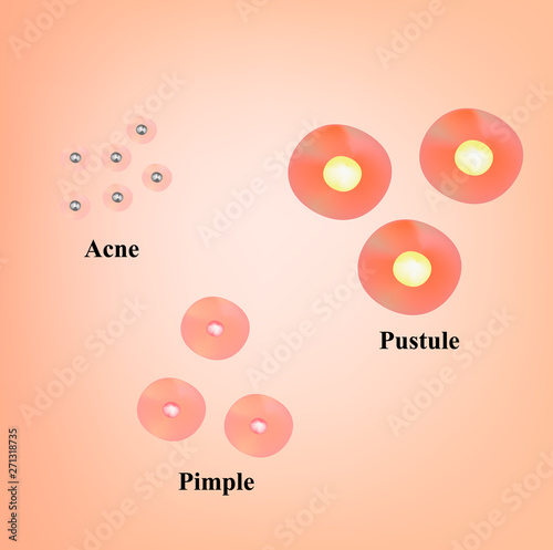 Types of blackheads, pustule, acne. Scarred skin after acne and acne. Infographics. Vector illustration on isolated background.