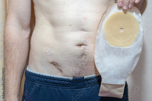 Man with scars on his stomach holds stoma colostomy bug. Chron's disease or colorectal cancer medicinal equipment cure health background concept. photo