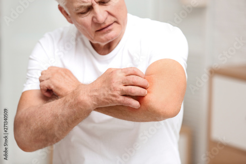 Senior man scratching forearm indoors, closeup. Allergy symptom