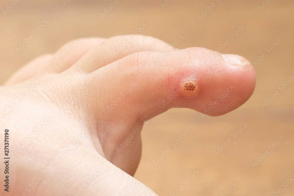 wart with papilloma