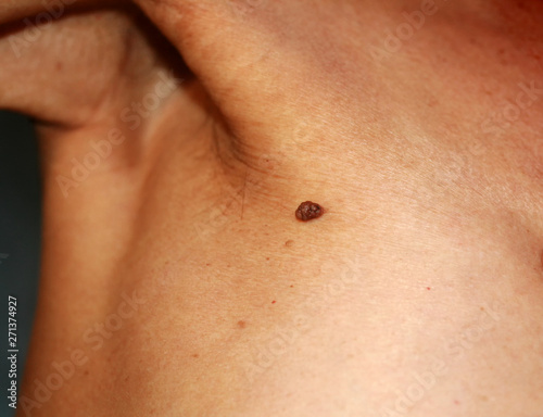 Birthmark of the armpit. Popiloma is large.