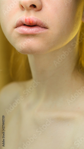 Herpes on the Upper Lip of a Young Woman