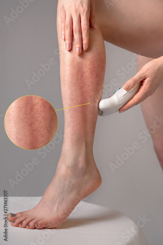 фотографія A young woman removes excess hair with a depilator