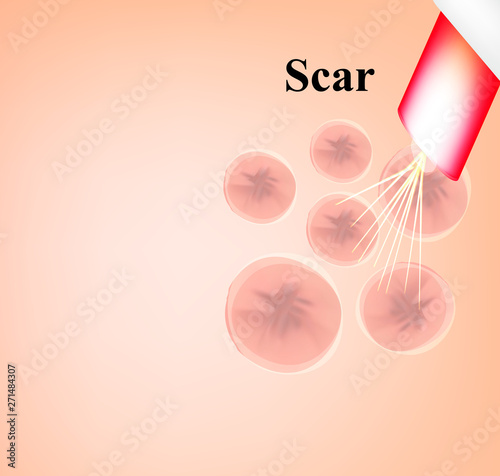 Skin scars after acne and pimples. Treatment of scars on the skin of the face with a laser. Infographics. Vector illustration on isolated background.