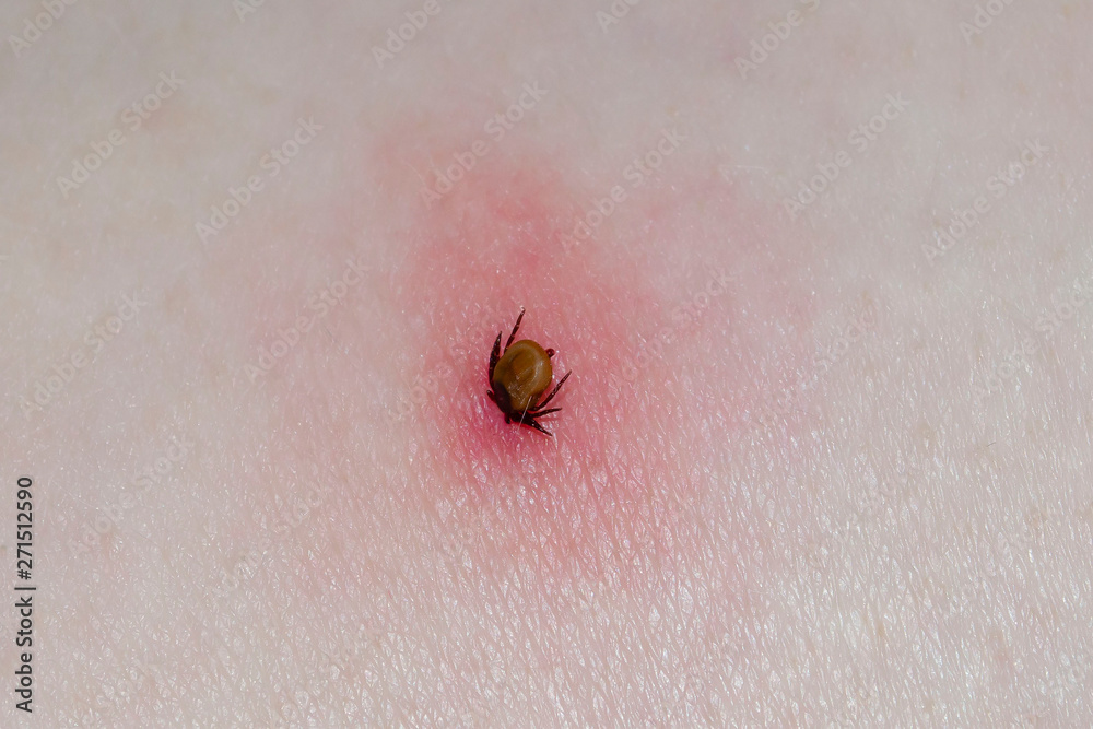 Tick With Its Head Sticking In Human Skin Stock Photo 