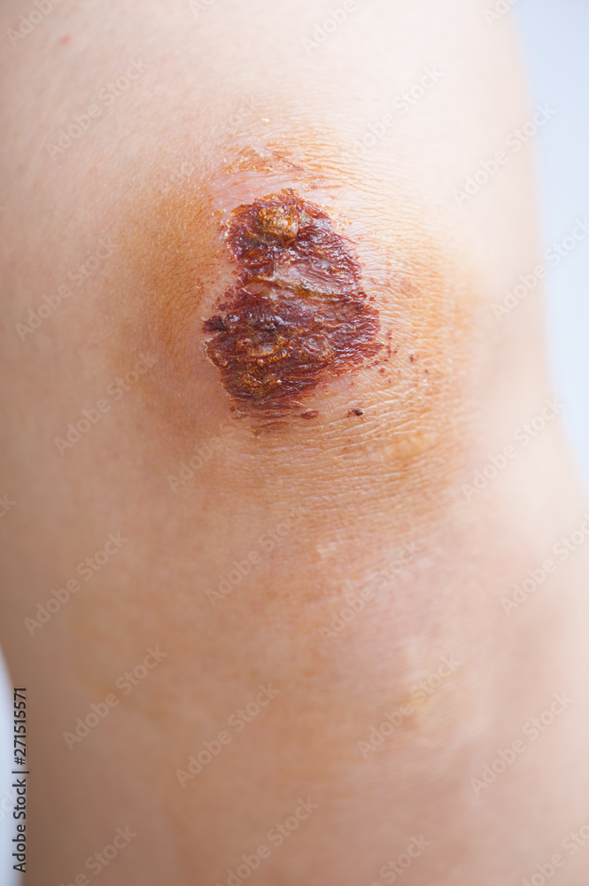 Scar and scab (eschar) on asian female knee