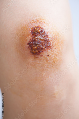 Obraz na płótnie Scar and scab (eschar) on asian female knee w salonie