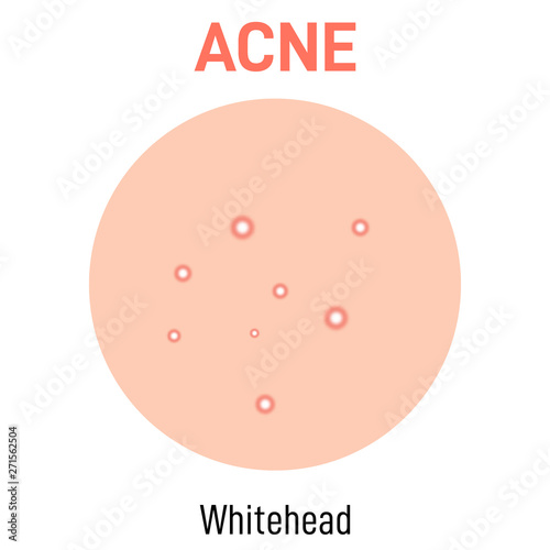 Whitehead skin acne type