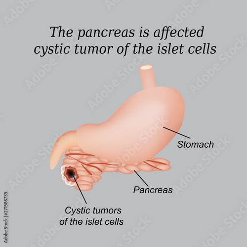 The pancreas is affected cystic tumor of the islet cells. Vector illustration on a gray background