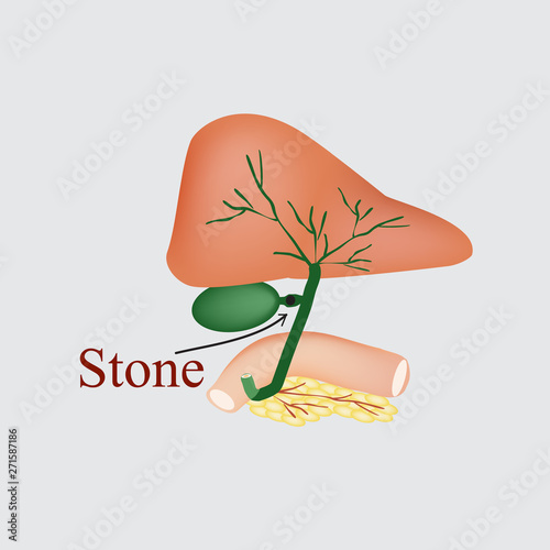 Stone bile duct. Gallbladder, duodenum, pancreas, bile ducts. Vector illustration on a gray background.