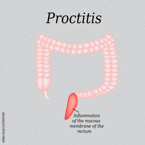 Colon. Proctitis. Vector illustration on a gray background photo