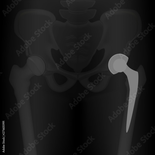 Vector illustration. X-ray of human total hip replacement. For advertisement and medical publications.