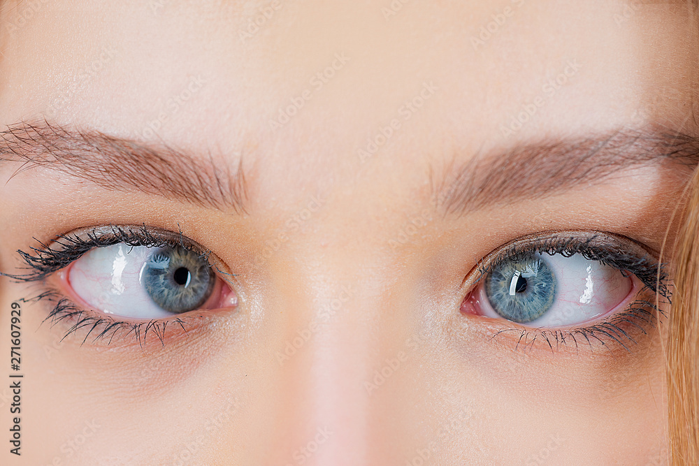 Strabismus Eye Surgery. Close up of crazy female eyes with squint. Eye
