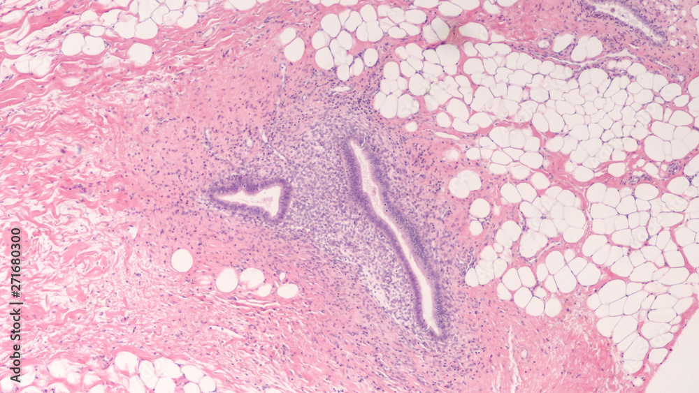 Microscopic image of endometriosis, a condition in which endometrial