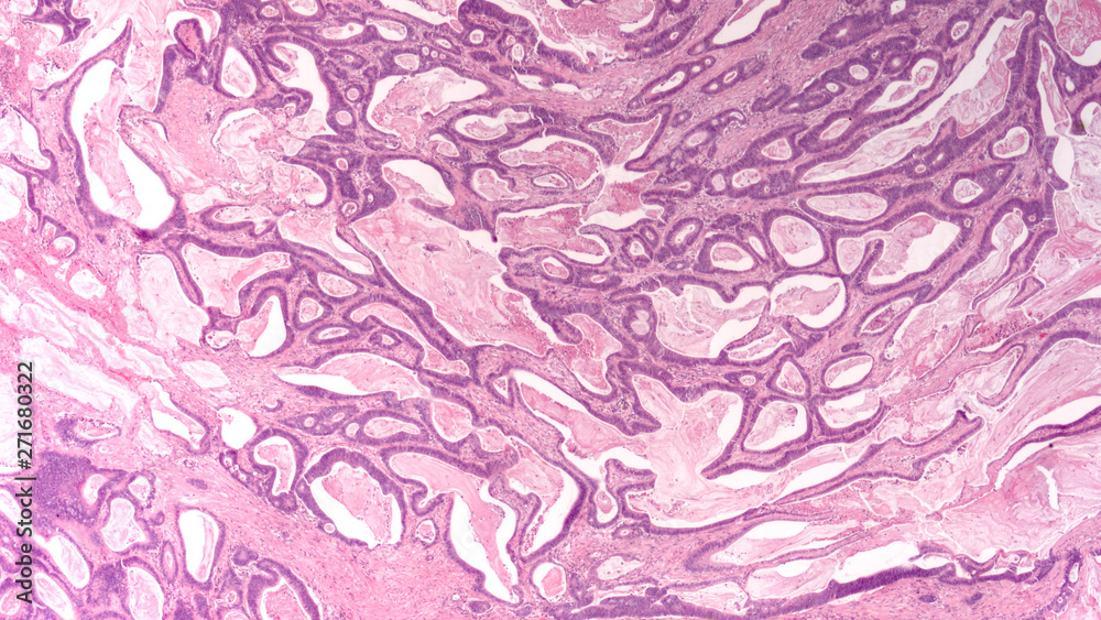 Colon Cancer Photomicrograph (microscopic image) of an invasive