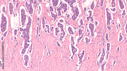 Photomicrograph of a neuroendocrine tumor (NET, aka carcinoid) of small intestine (ileum), with invasion of smooth muscle of bowel wall.  Spread to liver can cause symptoms of carcinoid syndrome. photo