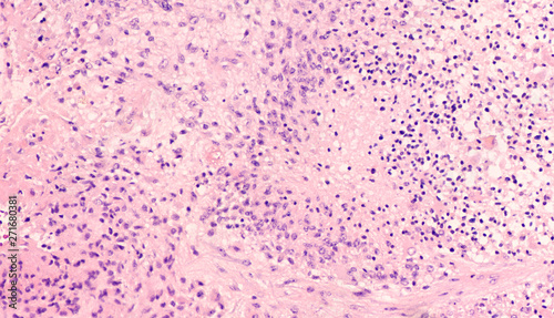 Microscopic image showing histology of a glioblastoma multiforme (GBM), a type of brain cancer.  Necrosis and vascular proliferation are diagnostic features of this high grade malignant tumor.  photo