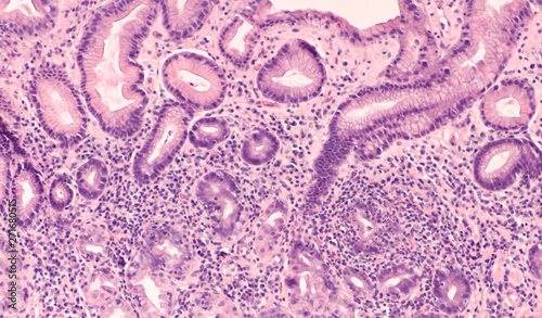 Microscopic image of an endoscopic gastric (stomach) biopsy showing chronic active gastritis (inflammation) due to Helicobacter pylori, a type of bacterial infectio photo