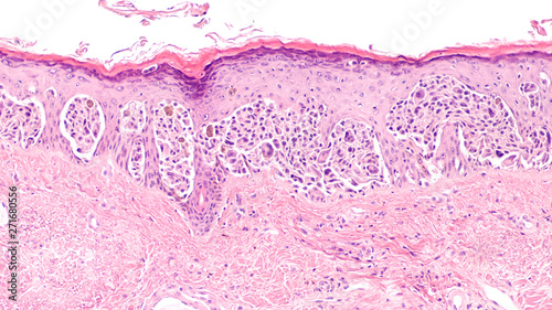 Melanoma in situ (MIS) is an early stage, while tumor cells are still confined to the epidermis, before invasion of dermis.  Excision at this stage is curative.  Use of sunscreen is preventative.  