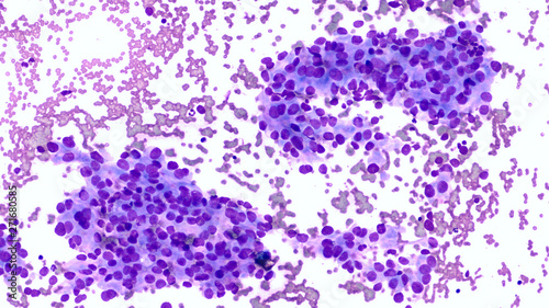 Microscopic image showing cancer cells (cytology) of adenocarcinoma of lung, obtained by cat scan (CT) guided fine needle aspiration (FNA), as part of a pulmonary nodule screening program. 