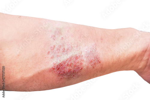 Atopic dermatitis  AD   also known as atopic eczema  is a type of skin inflammation  dermatitis  .