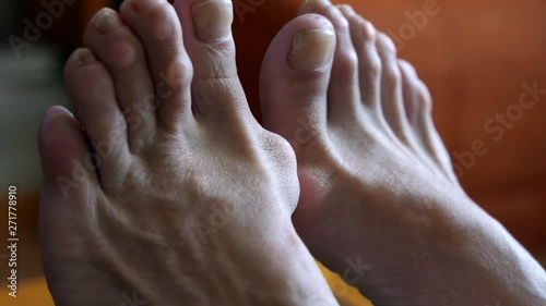 woman's foot with bunion photo