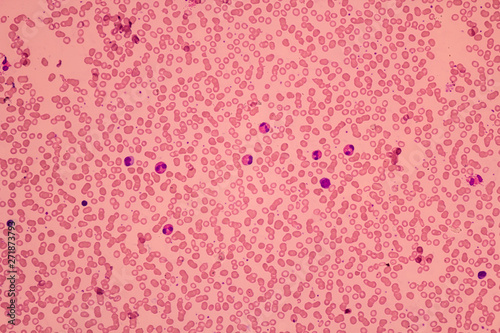 Human blood smear view in microscopy.Complete blood count for treatment. Polymorphonuclear cells(PMNs), eosinophils and lymphocytes.Hematology laboratory.Medical background.Magnification 600 x
