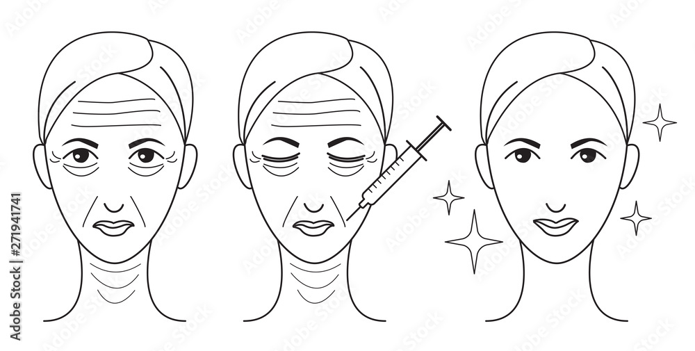Botox line woman face set