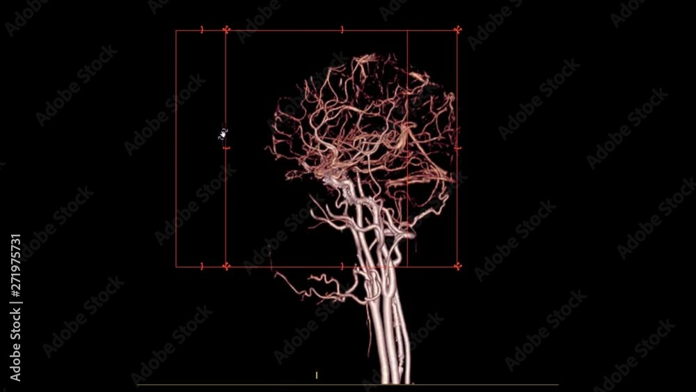 CTA Brain or computed tomography angiography of the brain a 3D ...