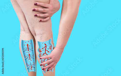 Fototapeta The varicose veins on a legs of woman