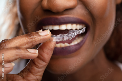 Woman Putting Transparent Aligner In Teeth