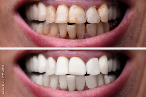 Woman Teeth Before And After Dental Treatment