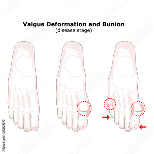 Age and valgus deformity of the thumb. Bunion. Stages of development of the disease. Silhouette of the foot bones. Vector illustration