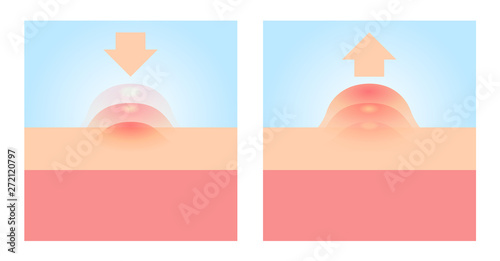 Acne and Pimples, stages of development, vector icon