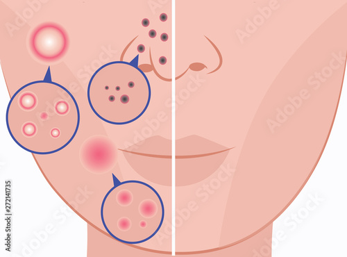 Comparison of healthy and problem skin flat vector illustration isolated.