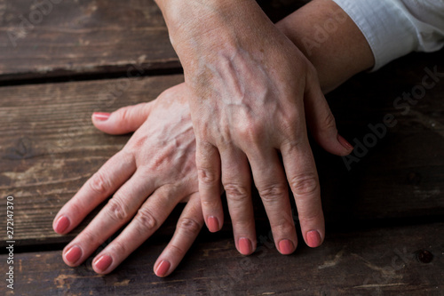 hands of woman with vitiligo