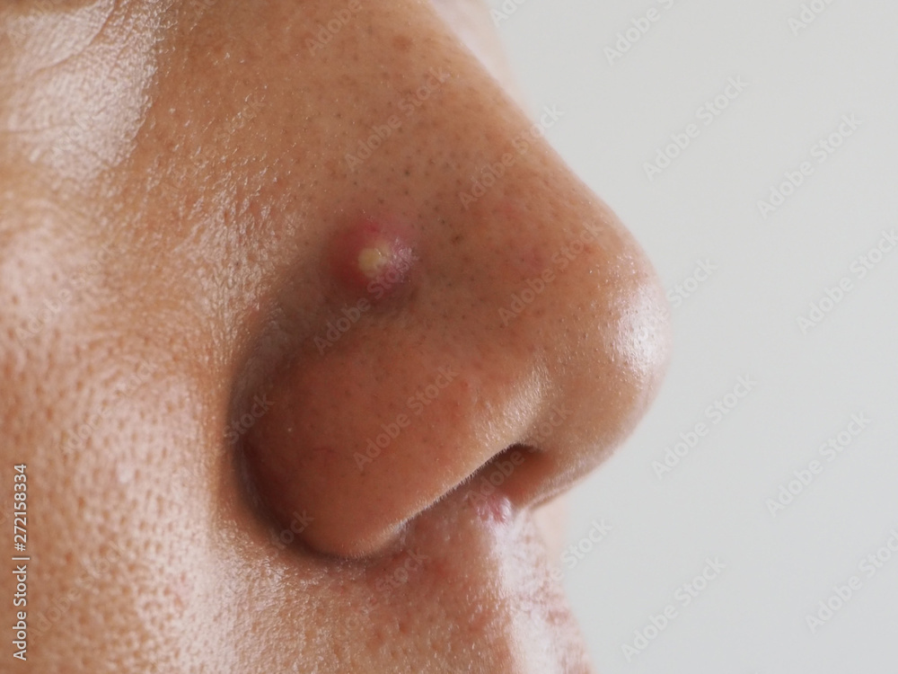 whitehead and blackhead on the nose women cause of oily face skin and large pore using for skincare and cosmetics or beauty product concept. whitehead and blackhead on the nose women cause of oily face skin and large pore using for skincare and cosmetics or beauty product concept.