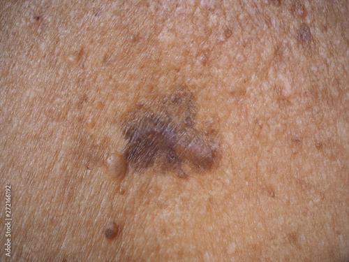 skin cancer or melanoma on collarbone type of superficial spreading be an existing spot, freckle or mole change color, size or shape caused by ultraviolet (UV) light damaging the DNA in skin cells. photo