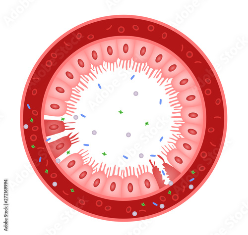 Celiac disease Small intestine lining damage. good and damaged villi . leaky gut progression	