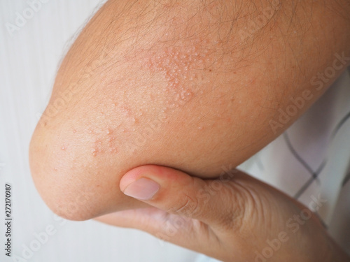 heat rash or prickly heat or miliaria on the skin asian woman, Cause of hot weather, food allergy or drug  and insect bite. Using for health care concept,  Close up shot photo.