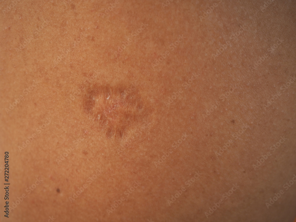 Fototapeta premium Contracture scar on arm skin women using for health care and beauty concept.