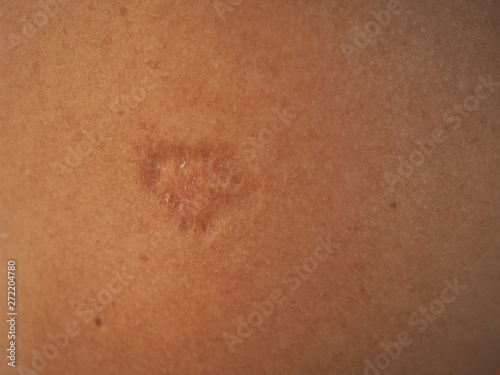 Contracture scar on arm skin women using for health care and beauty concept.